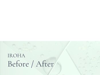 イロハ(IROHA)/ハーブピーリング/小顔/毛穴