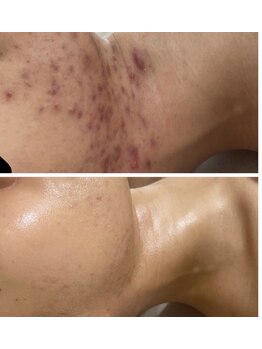 ヴィクトリアサロン(VICTORIA SALON)の写真/【本気の肌質改善】種類豊富な“肌質改善メニュー”で気になる肌悩みにアプローチ◎お肌を見違えらせます★