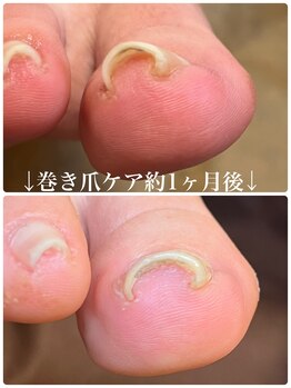 フットタイムズ(FOOT TIMES)/巻き爪ケアビフォーアフター