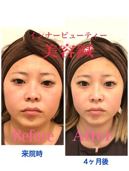 ハピネス(Happiness)/美容鍼イメージ2