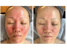 クリア 麻布十番(CLEAR)/シフォンピーリング　毛穴ケア