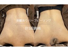 ライフ美容整体院 恵比寿(Life美容整体院)/背中のハーブピーリング