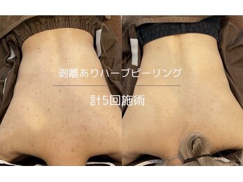ライフ美容整体院 恵比寿(Life美容整体院)/背中のハーブピーリング