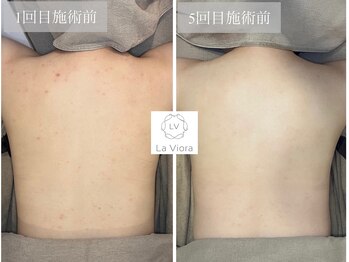 ラヴィオーラ 福島野田店(La Viora)/ダイヤモンドハーブピーリング