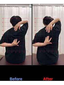 美田園5丁目接骨院/肩甲骨はがしbefore⇒after