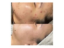 ニキビやくすみも無くなって肌荒れしにくい、安定したお肌に！