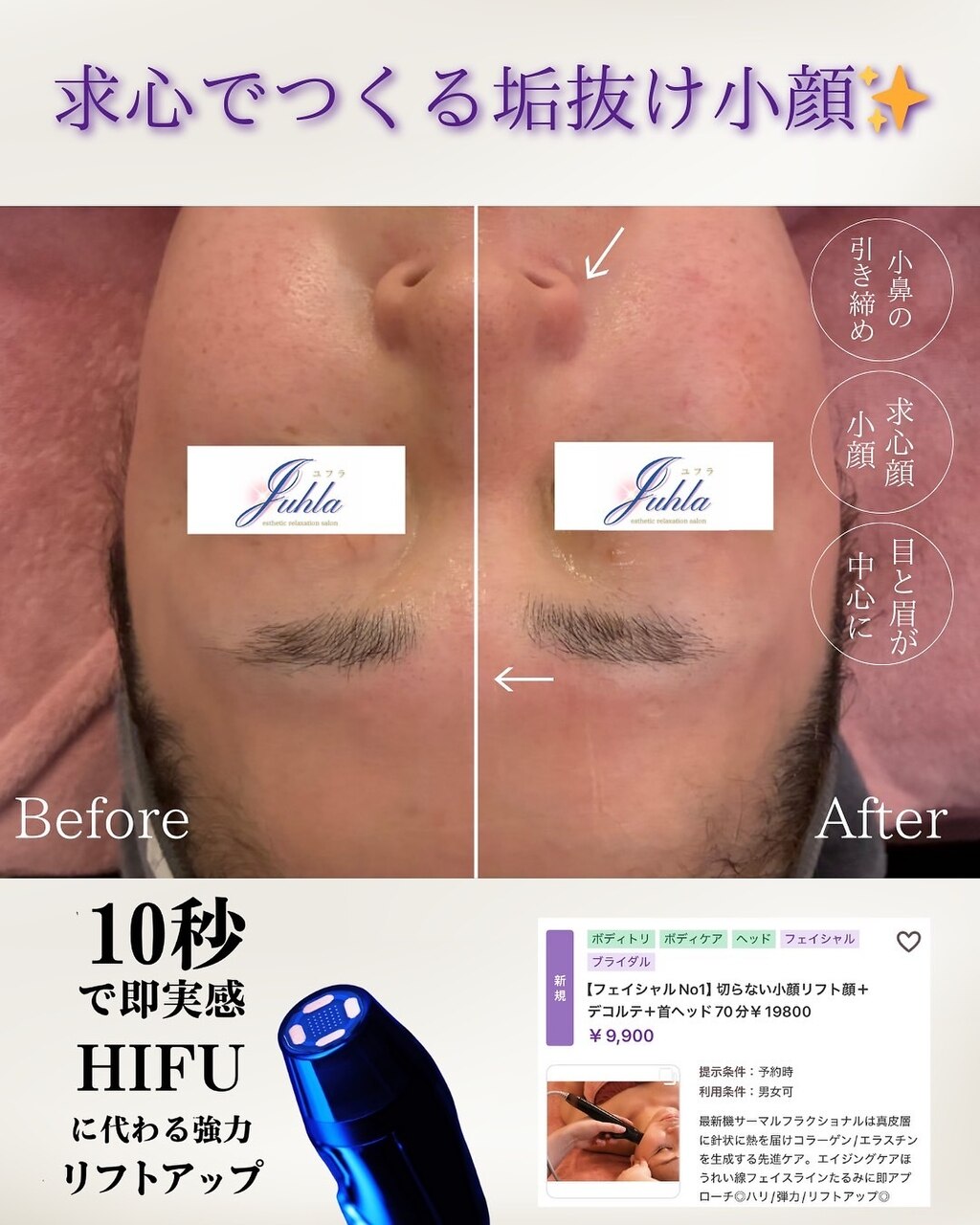 次世代リフトアップ　◽︎ サーマルフラクショナル ◽︎ フラクショナルRF 新古品 次世代リフトアップ ◽︎ サーマルフラクショナル ◽︎ フラクショナル