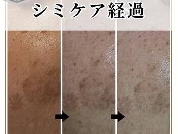 エヌエクラ(N.eclat.)/シミも薄く！