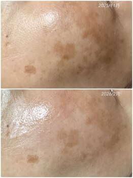 ブライトリー(Brightly)/最新光フェイシャル×ラエッセ