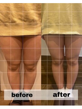 長寿鍼灸院 長寿整骨院/EMS＜太もも集中コース＞