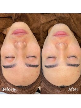 ビトタン 倉敷本店(+美to鍛)/ハーブピーリング1g/1回