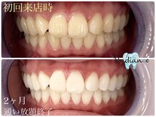 札幌セルフホワイトニング ラディアンス(Radiance)/2ヶ月通い放題