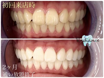 札幌セルフホワイトニング ラディアンス(Radiance)/2ヶ月通い放題