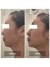 【憧れのモデル級”極小顔"】美容溶解成分で脂肪分解  極小顔コース　16500～