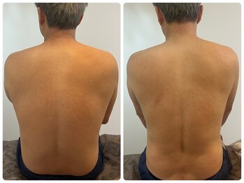 ピンクマジック(PINKMAGIC)/リリースカッター施術ビフォアフ