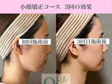 キュープ 表参道店(Qpu)/ 小顔矯正3回コースの変化