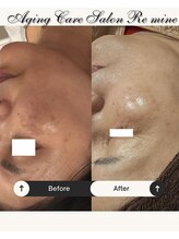 リマイン(Re mine)/濃いシミも肌全体を美白に