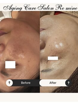 リマイン(Re mine)/濃いシミも肌全体を美白に