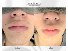 アン ビューティー(ann beauty)/施術3回【症例写真】
