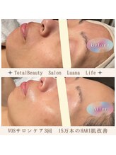 ルアナライフ(Luana Life)/新ピーリング/微細針で肌質改善