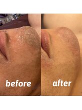 ダリオムズ 西宮北口(DAHLI HOMMES)/☆メンズヒゲ脱毛☆施術2回目