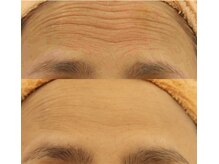 ファニービー 吹田店/40代 シワ 6ヶ月で改善