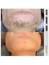 ラポール(rappore;)/メンズヒゲ脱毛