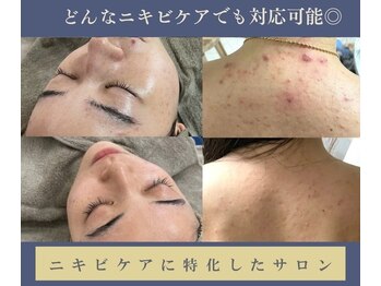 グリッター ショウナン(glitter.SHONAN)の写真/1度でもしっかり体感◎不要な汚れを取り除きニキビケアに集中！ハーブピーリングの力で肌悩み0へ!!