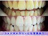 【再来４照射】更にトーンアップ！プラチナムホワイトニング15分×4回照射♪