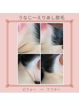 ノノ(nono)/うなじ～えりあし脱毛♪