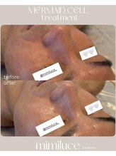 ミミルーチェ(mimiluce)/マーメイドセルトリートメント