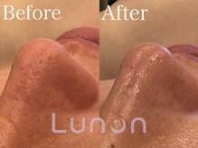 ルノン(Lunon)/毛穴洗浄ハイドロ