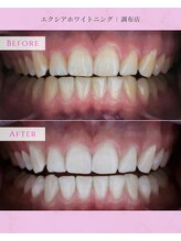 エクシアホワイトニング 調布店/20代女性会員様/3ヶ月の変化
