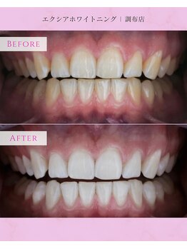 エクシアホワイトニング 調布店/20代女性会員様/3ヶ月の変化
