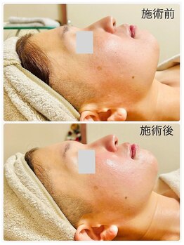 ミニン(minin)/小顔矯正