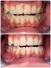 コントレール 歯ぁと(CONTRAIL)/ビフォーアフター