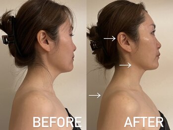 アンミー(anmiiy)/30代後半エアバリ変化/首肩頭