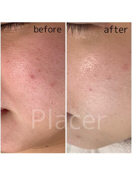 プラセル(Placer)/化粧品だけで