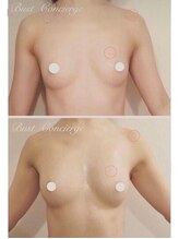 デミーナ(Demyna)/【バストアップ・育乳】症例