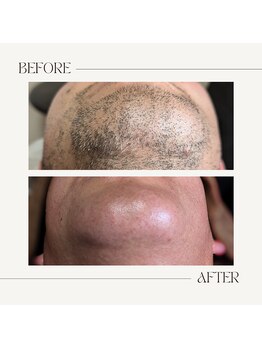 スプランドゥール(Splendeur)/メンズ【ひげ】WAX+光