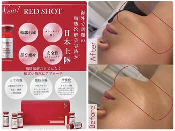 ナナラ(NANALA)/新メニュー 脂肪分解美容液