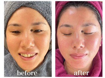 ルー ハナレ 神戸岡本 摂津本山店(Luu HANARE)/フェイスライン小顔　３回