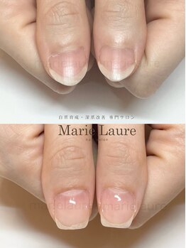 マリーロール 梅田店(Marie Laure)/深爪矯正/自爪育成/自爪風