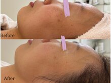 ブライス(BLITHE)/before after