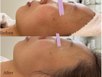 ブライス(BLITHE)/before after