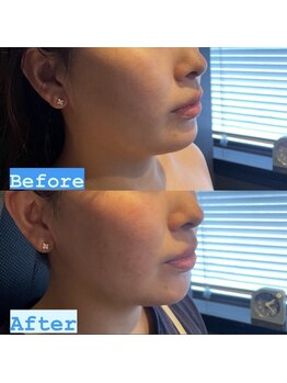 アディクト(Addict)/Before＆After