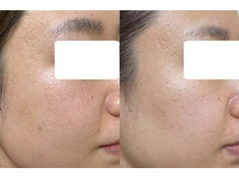 エミュ(emu)/◆美白・色素トラブル・毛穴