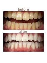 セルフホワイトニング専門店　 ホワイトニングショップ船橋2号店【ホワイトニング】/Before&After美白ホワイトニング