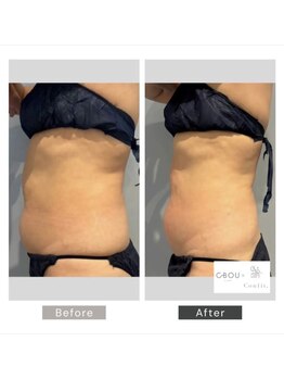 シーボウ(CBOU)/脂肪よう解　10ml(お腹)