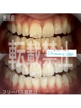 ホワイトニングサロン 福岡天神店/ホワイトニング